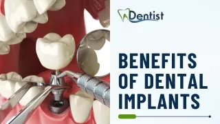 Benefits of Dental Implants