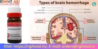 Carcinosin 200 Hemorrhage Relief & Pain Alleviation Dilutions