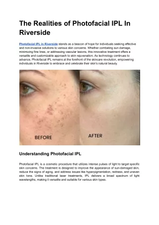 The Realities of Photofacial IPL In Riverside