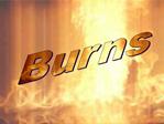 Burns ppt