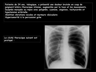 Patiente de 24 ans, tabagique, a présenté une douleur brutale en coup de poignard latéro-thoracique intense, augmentée p