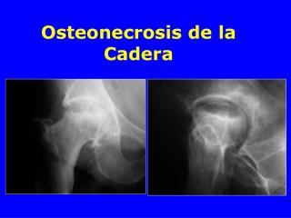 Osteonecrosis de la Cadera