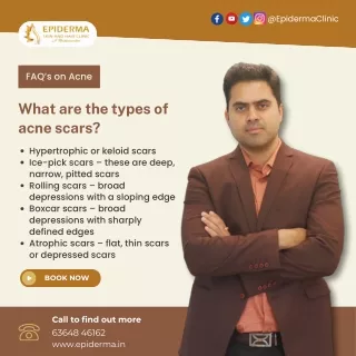 Types of acne scars | Best Skin Clinic in Jayanagar | Epiderma Clinic