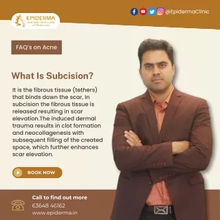 What Is Subcision | Skin Clinic in Jayanagar | Epiderma Skin and Hair Clinic
