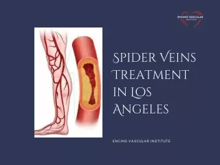 Spider Veins Treatment in Los Angeles