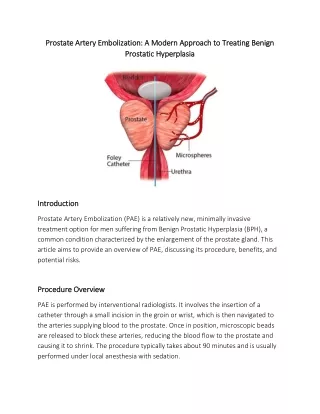 Prostate Artery Embolization