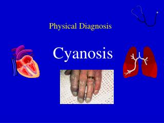Physical Diagnosis Cyanosis