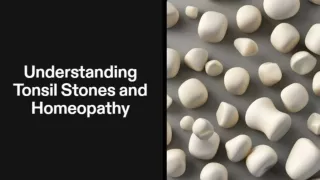 Tonsil Stones: Symptoms & Homeopathy Treatment