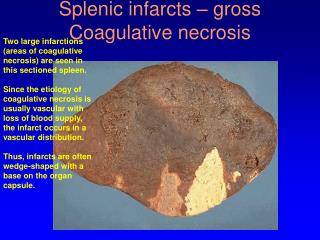 Splenic infarcts – gross Coagulative necrosis