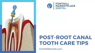 Post Root Canal Tooth Care Tips