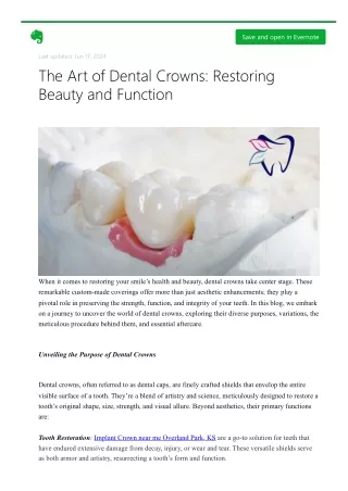 The Art of Dental Crowns Restoring Beauty and Function