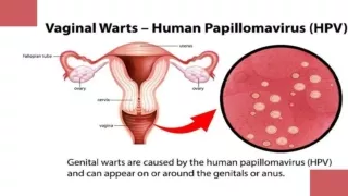 Human Papilloma Virus