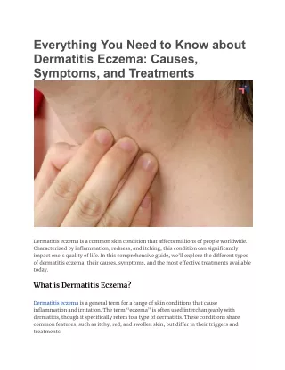 Everything You Need to Know about Dermatitis Eczema_ Causes, Symptoms, and Treatments