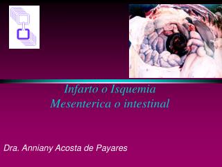 Infarto o Isquemia Mesenterica o intestinal