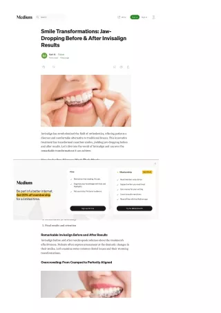Smile Transformations Jaw-Dropping Before & After Invisalign Results