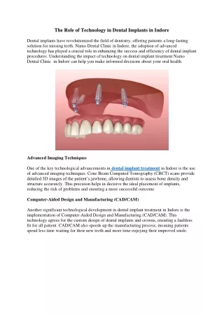 The Role of Technology in Dental Implants in Indore