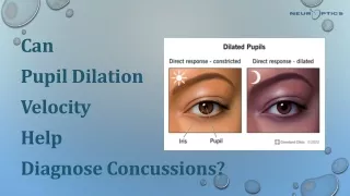 Can Pupil Dilation Velocity Help Diagnose Concussions