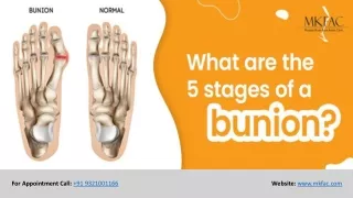 What Are The 5 Stages Of A Bunion | MKFAC