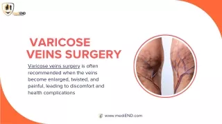 Varicose Veins Symptoms, Causes and Treatments