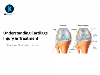 Understanding Cartilage Injury & Treatment