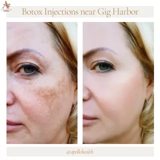 Botox Injections near Gig Harbor