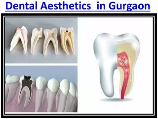 Root Canal Treatment in Gurgaon Basic Information