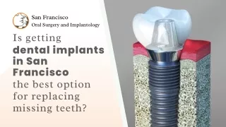 Is getting dental implants in San Francisco the best option for replacing missing teeth