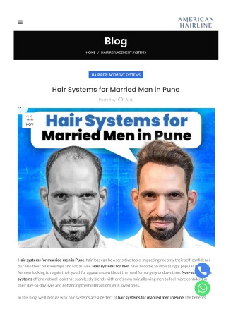 Hair Systems for Married Men in Pune