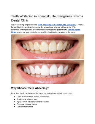 Teeth Whitening in Konanakunte, Bengaluru Prisma Dental Clinic