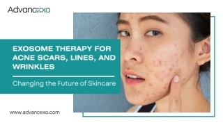 Exosome Therapy for Acne Scars, Lines, and Wrinkles