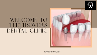 Revive your natural smile with dental implants Tijuana