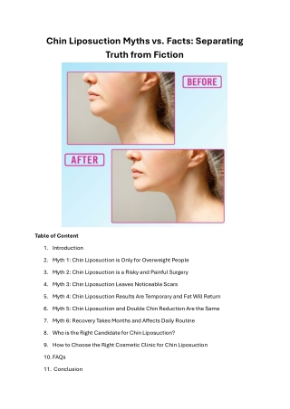 Chin Liposuction Myths vs Facts Separating Truth from Fiction