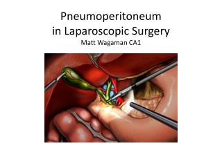 Pneumoperitoneum in Laparoscopic Surgery Matt Wagaman CA1