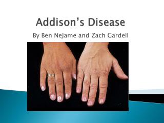 Addison’s Disease