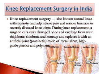 Knee replacement surgery