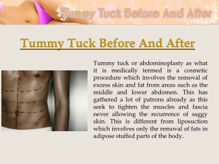 Tummy Tuck Pictures