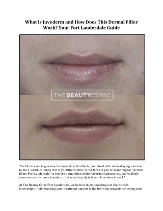 Juvederm Procedure Explained Clearly & Simply - The Beauty Clinic