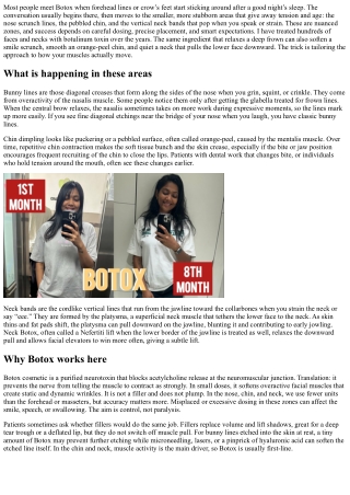 Botox for Bunny Lines, Chin, and Neck: Targeted Fixes