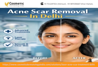 Acne Scar Removal In Delhi