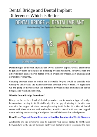 Dental Bridge and Dental Implant Difference: Which is Better
