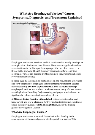 What Are Esophageal Varices? Causes, Symptoms, Diagnosis, and Treatment Explaine