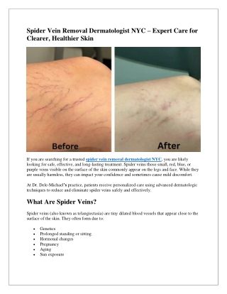 Spider Vein Removal Dermatologist NYC | Advanced Vein Treatment