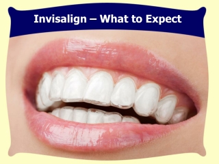Invisalign San Diego- Invisalign: What to expect
