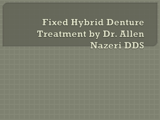 Fixed Hybrid Denture Treatment by Dr. Allen Nazeri DDS