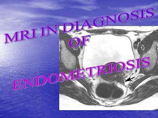 MRI IN DIAGNOSIS OF ENDOMETRIOSIS