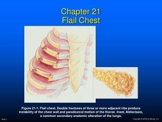 Chapter 21 Flail Chest