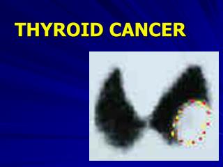 THYROID CANCER