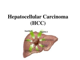 Hepatocellular Carcinoma (HCC)