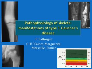 Pathophysiology of skeletal manifestations of type 1 Gaucher’s disease