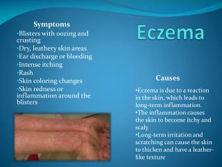 PPT - Eczema PowerPoint Presentation, free download - ID:1995031